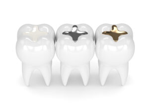 Can you use Advanced TRS with metal fillings?